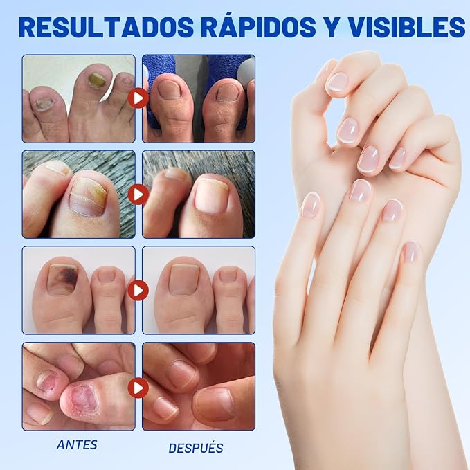 🍄 Parches Reparadores para Hongos en las Uñas (21 Parches)