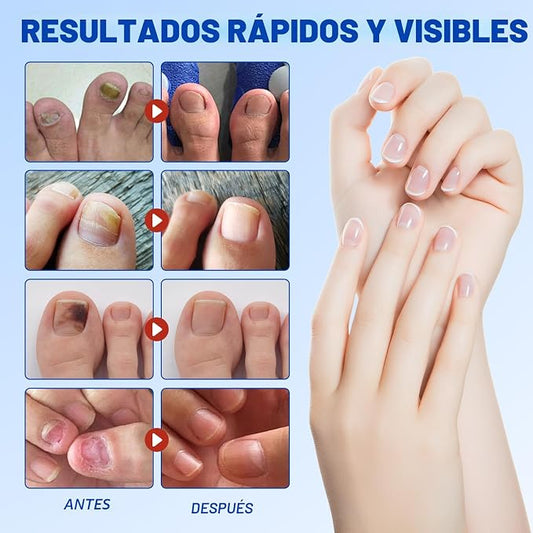 🍄 Parches Reparadores para Hongos en las Uñas (21 Parches)